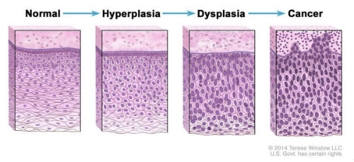 hyperplasia dysplasia cancer progression article1