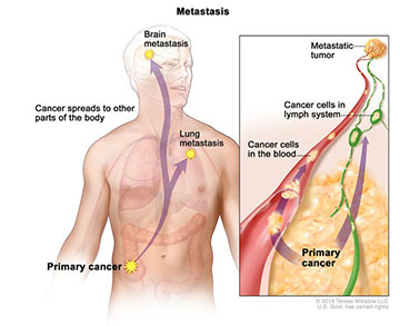 metastasis article
